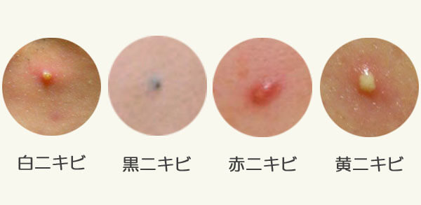 ホームケアとトリートメント